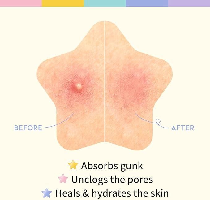 180 Pcs Pimple Patches